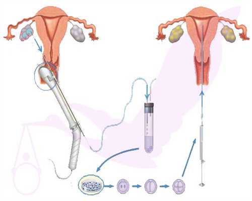代怀孩子多少钱_代怀生子正规公司_健康指南：铜仁试管婴儿多少钱明细表